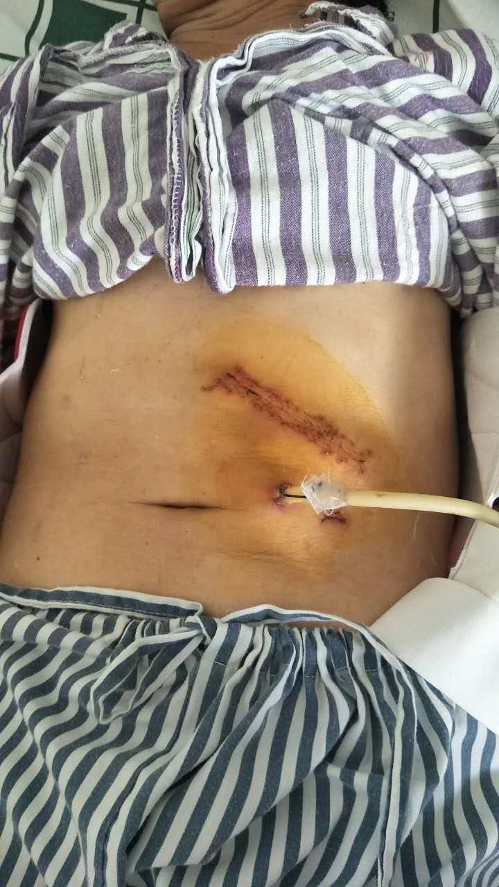 术后术口愈合良好3.jpg 术后术口愈合良好3.jpg