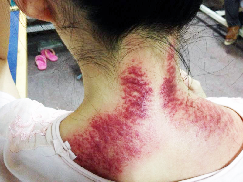 刮痧6.jpg 刮痧6.jpg
